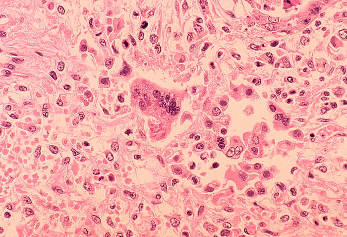 Histopathology of measles pneumonia: a multinucleated giant cell with intracytoplasmic inclusions, H&E stain