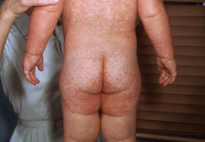 A child with measles showing the characteristic red blotchy rash on the third day